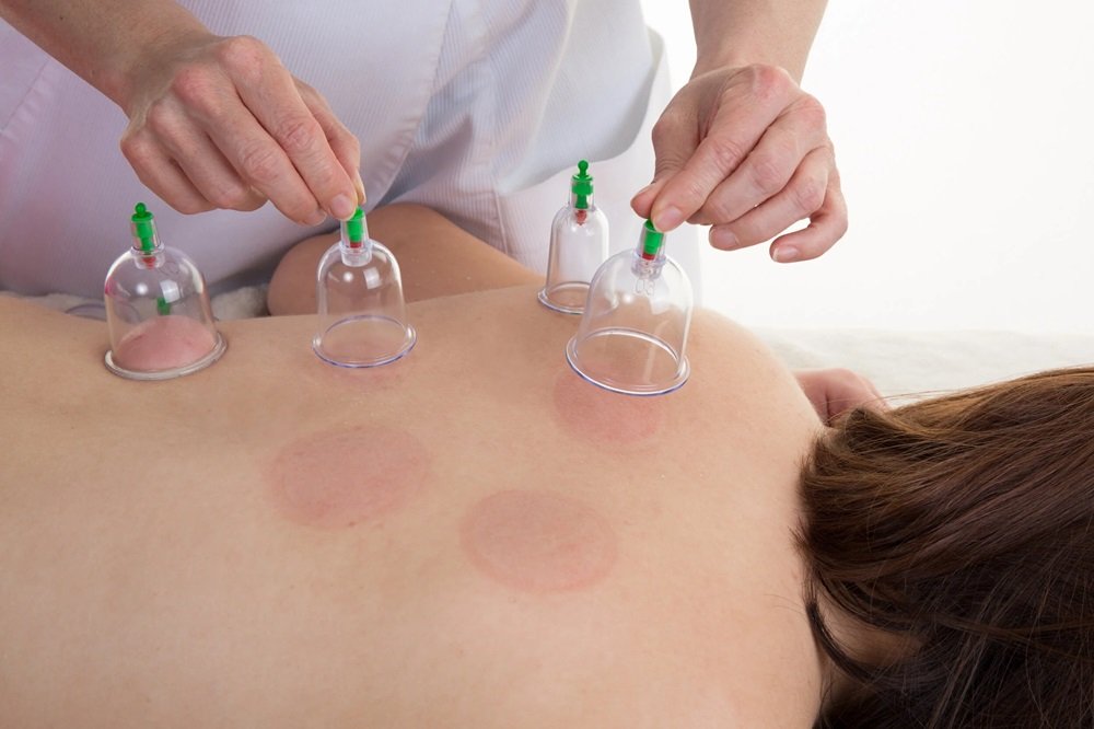 Cupping+3