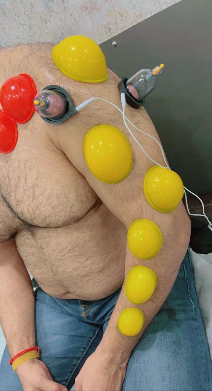 Cupping Therapy