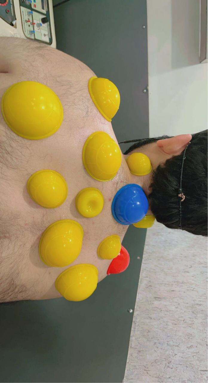 Cupping Therapy