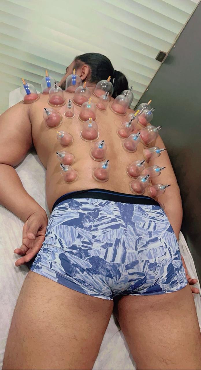 Cupping Therapy