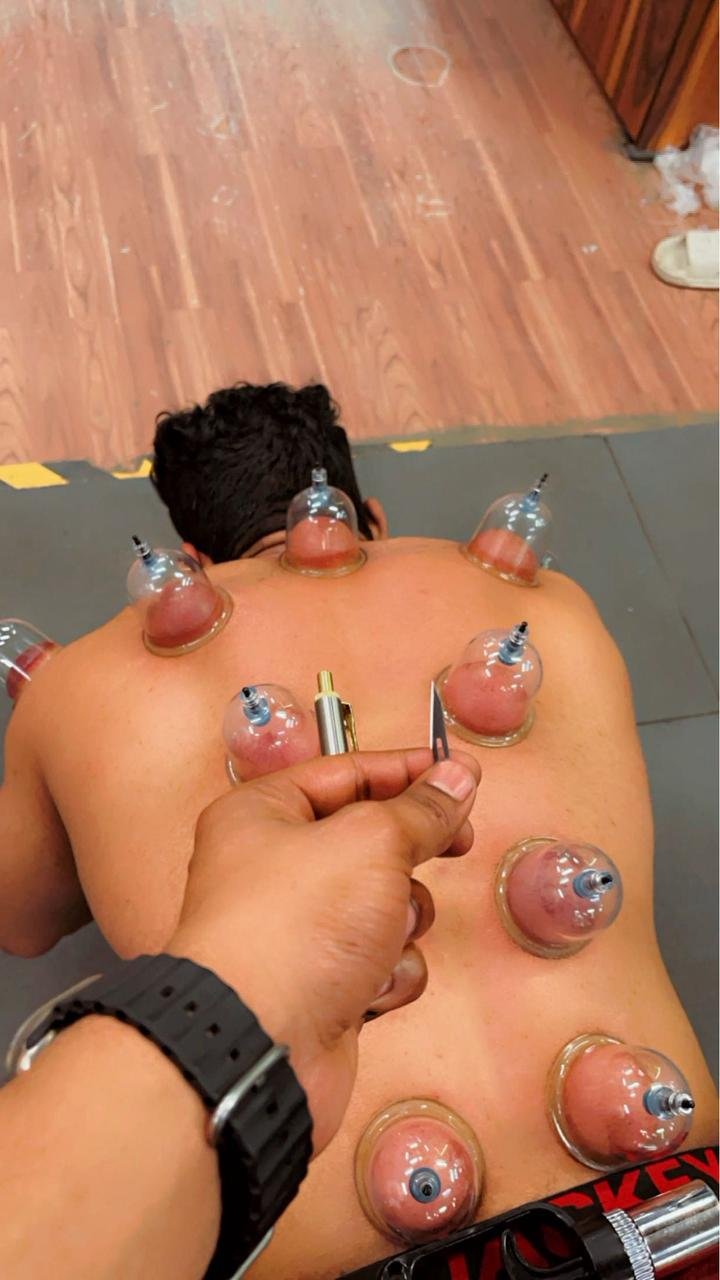 Cupping Therapy